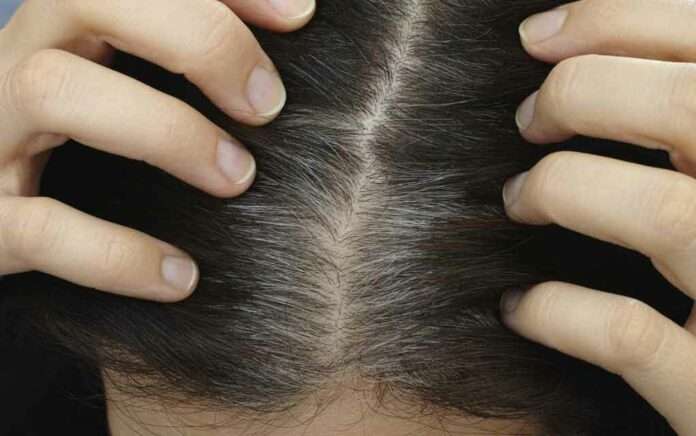 Follow-these-few-home-remedies-for-grey-hair-problem
