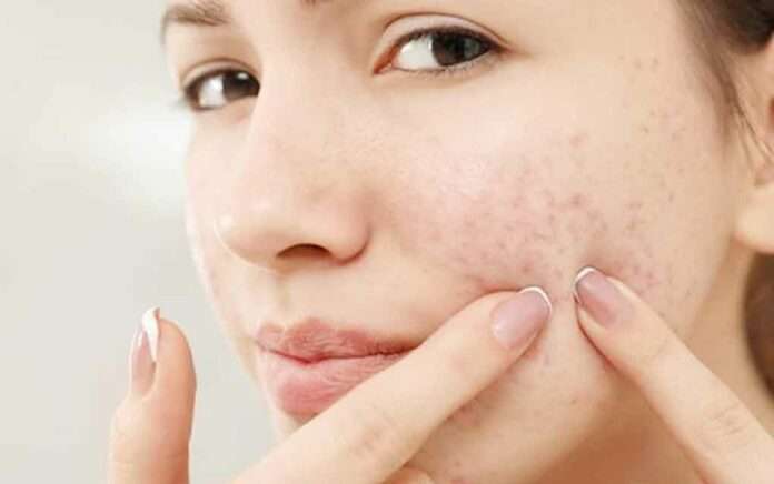 garlic-help-to-remove-acne