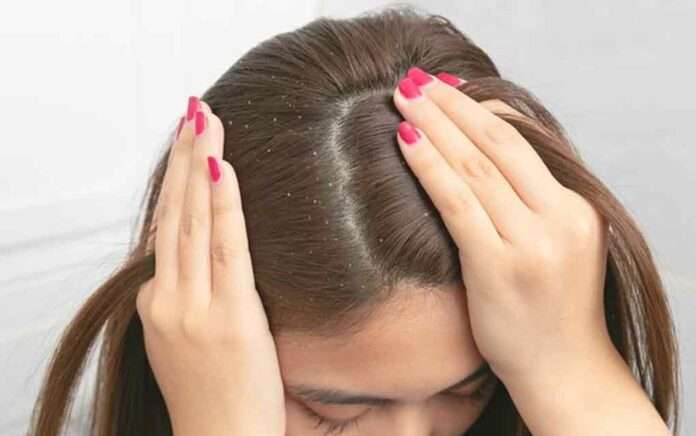 Dandruff problem solution is to mix this ingredient with shampoo